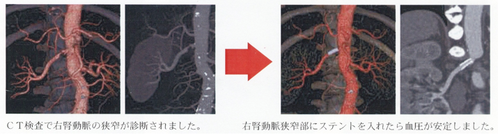 腎動脈狭窄症