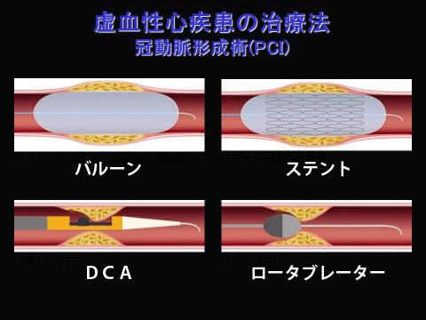 虚血性心疾患の治療法 冠動脈形成術(PCI) バルーン、ステント、DCA、ロータブレーター