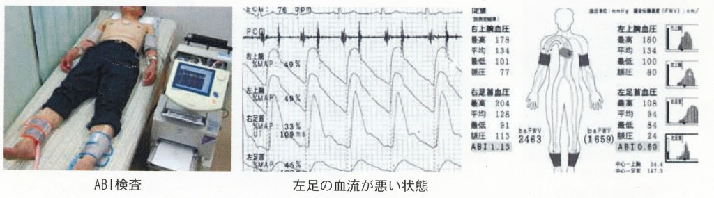 ABI検査