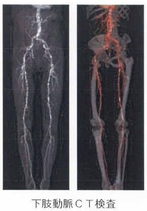 下肢動脈CT検査1