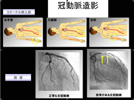 冠動脈造影