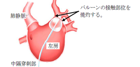 発作性心房細動に対するホットバルーン法