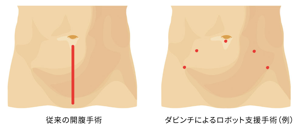 ロボット支援手術の傷口