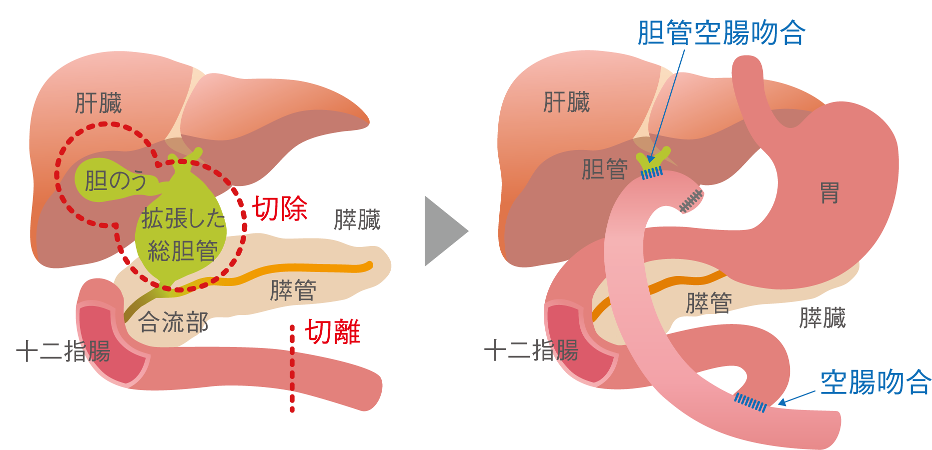 動脈閉鎖形成術の目的