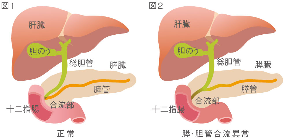 心房中隔欠損症